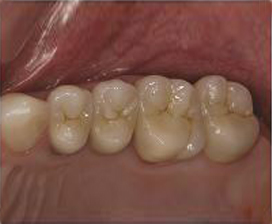 Emax metal-free porcelain crowns