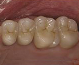 Emax metal-free porcelain crowns