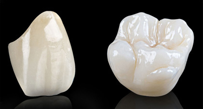 Examples of Emax porcelain crowns