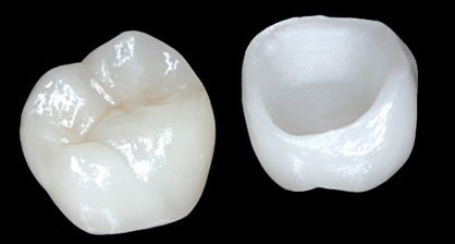Examples of Emax porcelain crowns