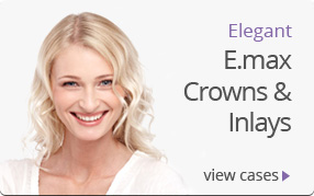 Elegant E.max Crowns & Inlays
