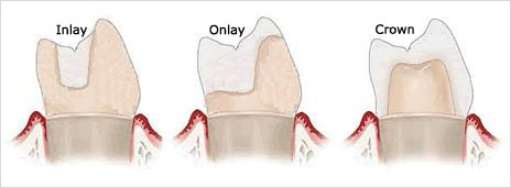 Comparison of a dental inlay, onlay and crown