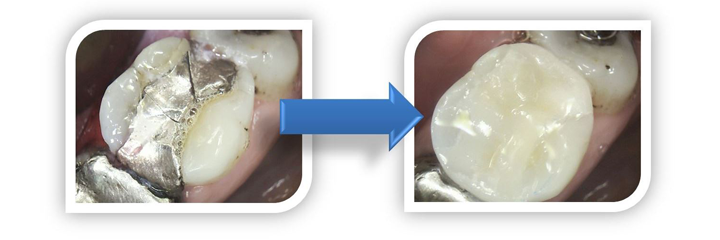 Replacement of a fractured amalgam filling with an Emax porcelain inlay