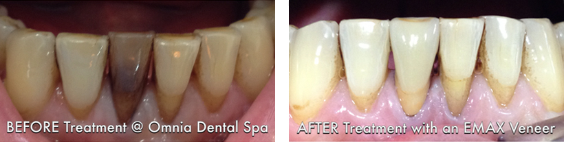 Veneer Case